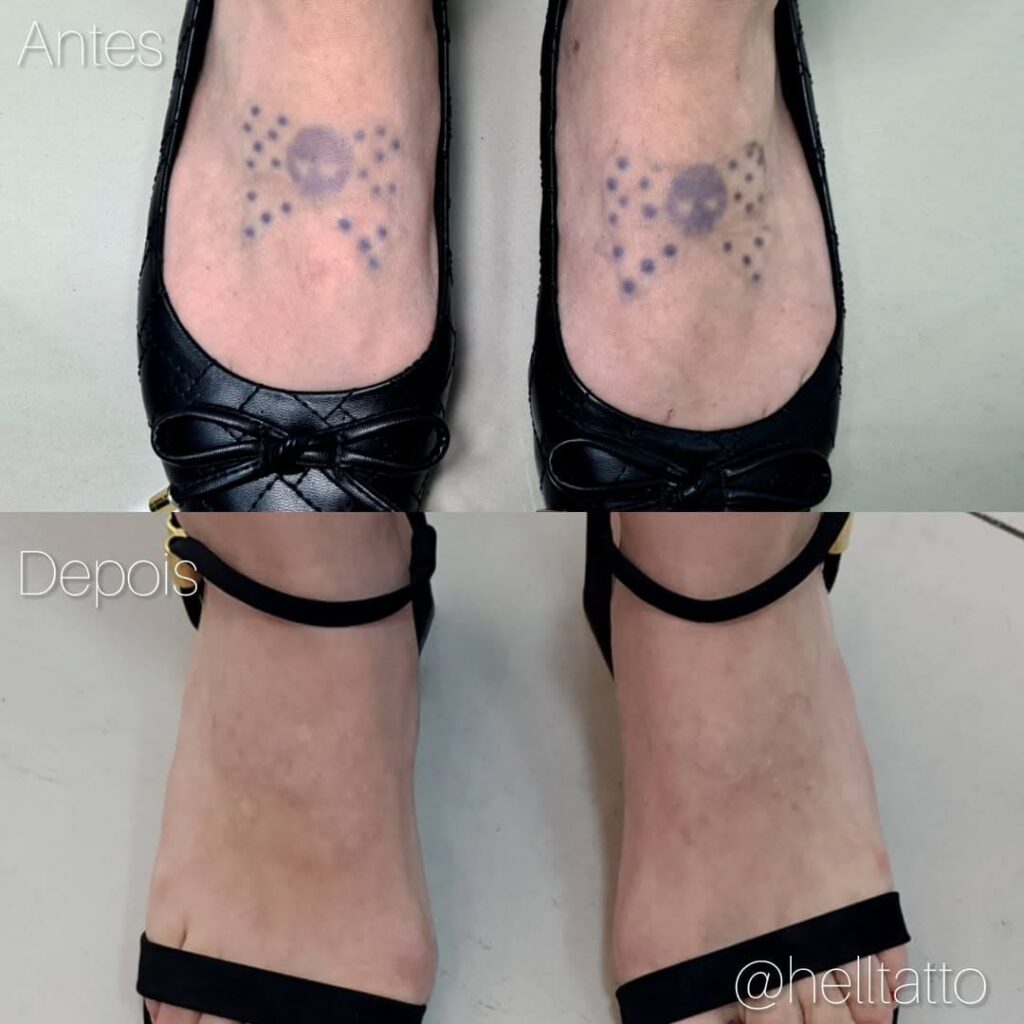 Cicatrização Da Tatuagem Conheça As Três Fases E O Que Pode Ocorrer