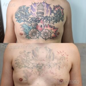 Onde-remover-tatuagem-azul-e-verde-em-São Paulo