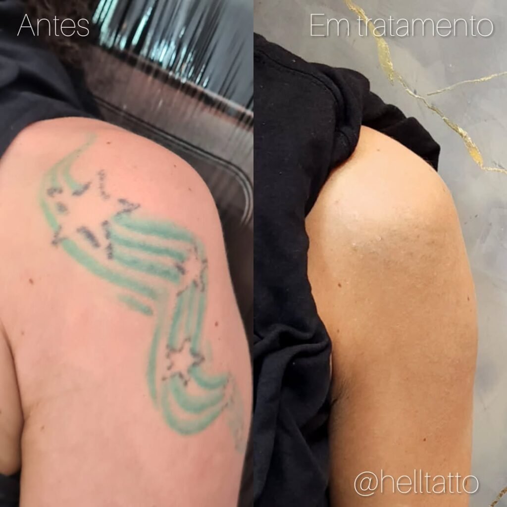 Onde remover tatuagem azul e verde em são paulo 01