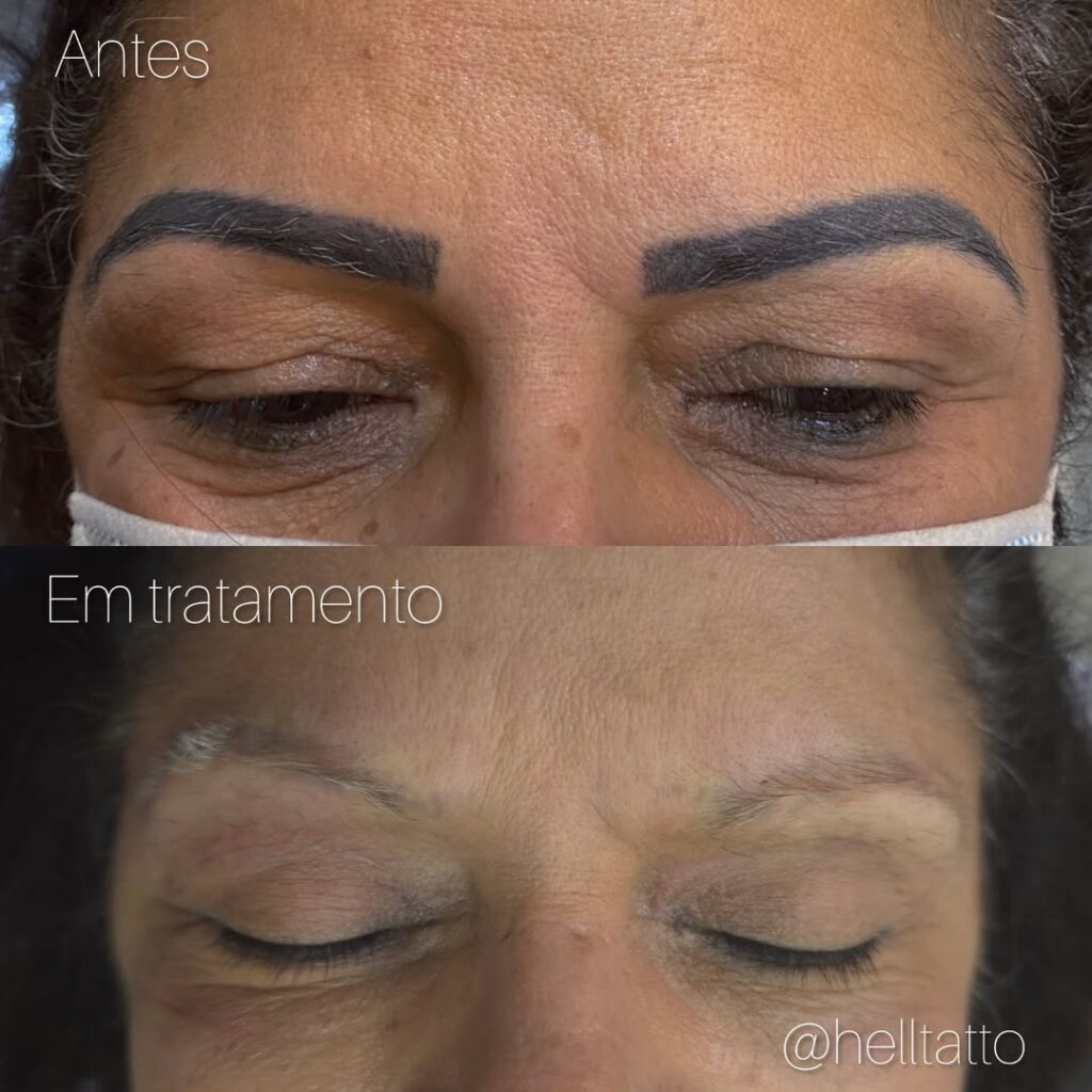 Cicatrização Da Tatuagem Conheça As Três Fases E O Que Pode Ocorrer