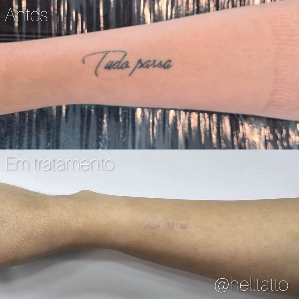 remover-uma-tatuagem-recem-feita