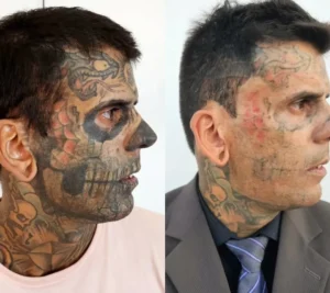 Remoção de tatuagem homem mais tatuado do Brasil 02