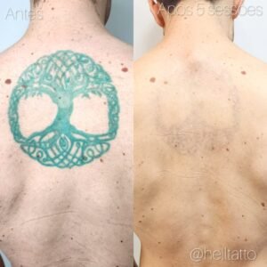 Tatuagem mais fácil de remover