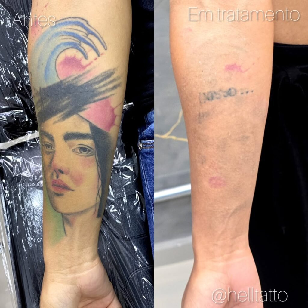 Antes e depois remoção de tatuagem a laser hell tattoo