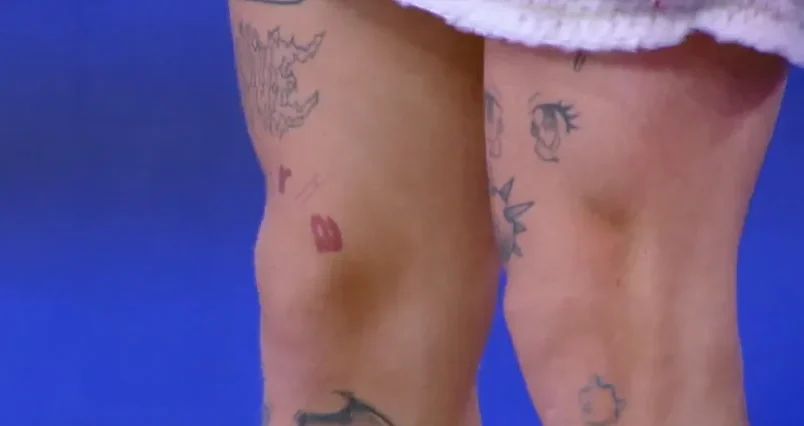 João Guilherme remoção de tatuagem