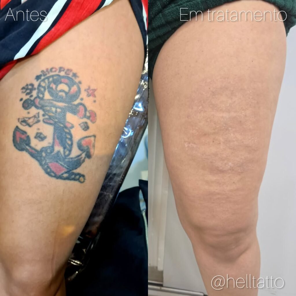 antes-e-depois-remoção-a-laser