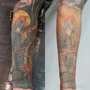 remocao-de-tatuagem-grande-tudo-que-voce-precisa-saber