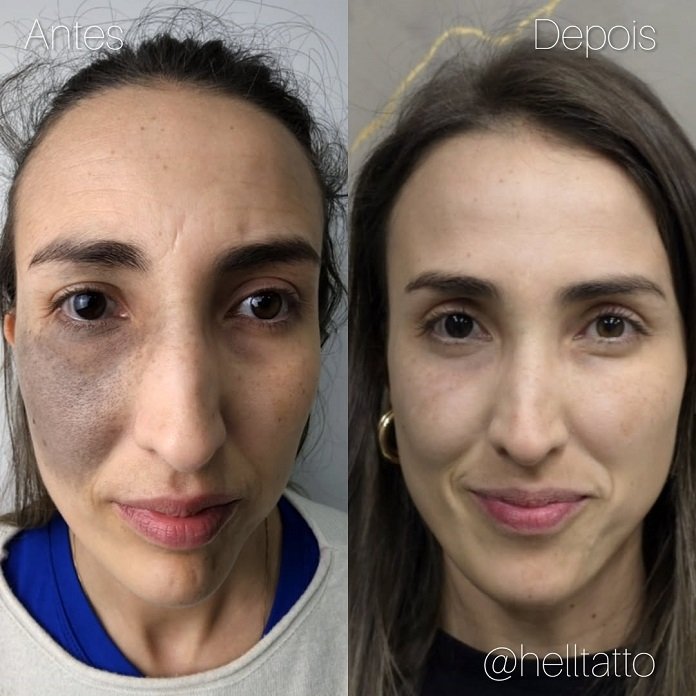 confira-resultado-de-nevo-de-ota-depois-de-6-sessoes-02