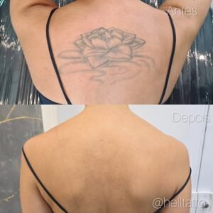quantas-sessoes-serao-necessarias-para-remover-uma-tatuagem