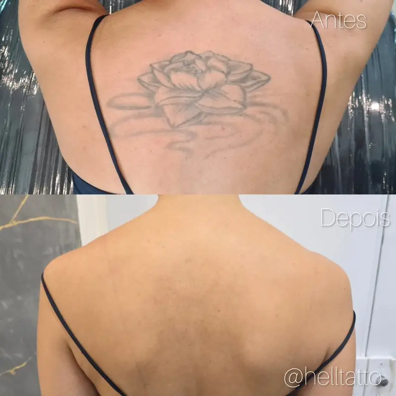 quantas-sessoes-serao-necessarias-para-remover-uma-tatuagem