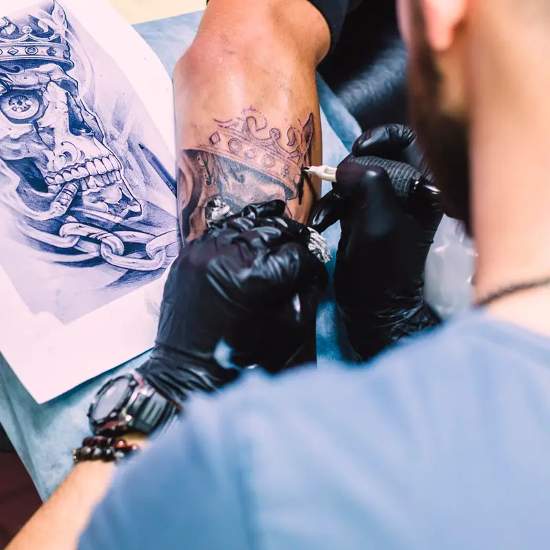 tatuagem_remoção de tatuagem