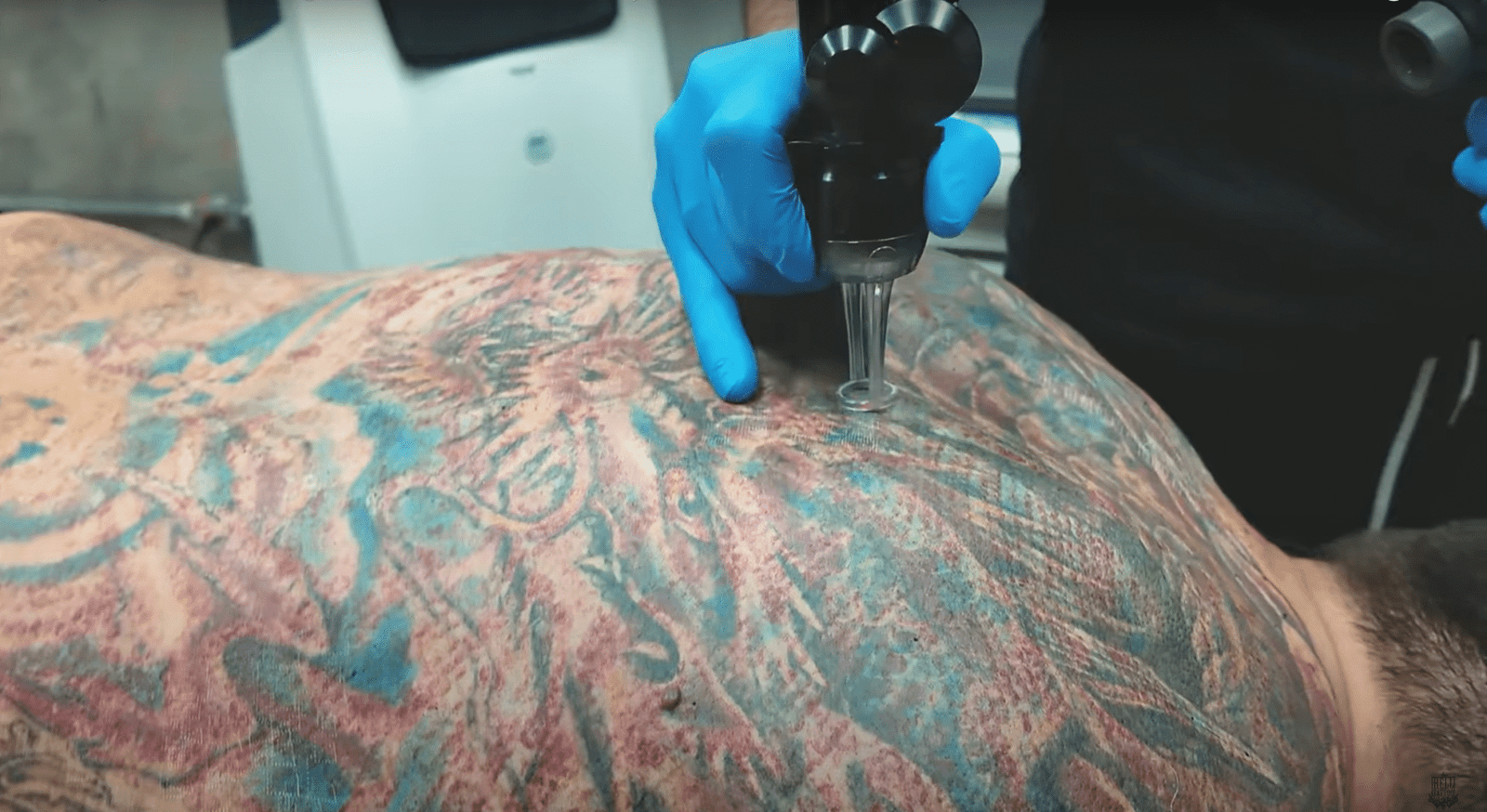 Laser de CO2 Fracionado e remoção de tatuagem