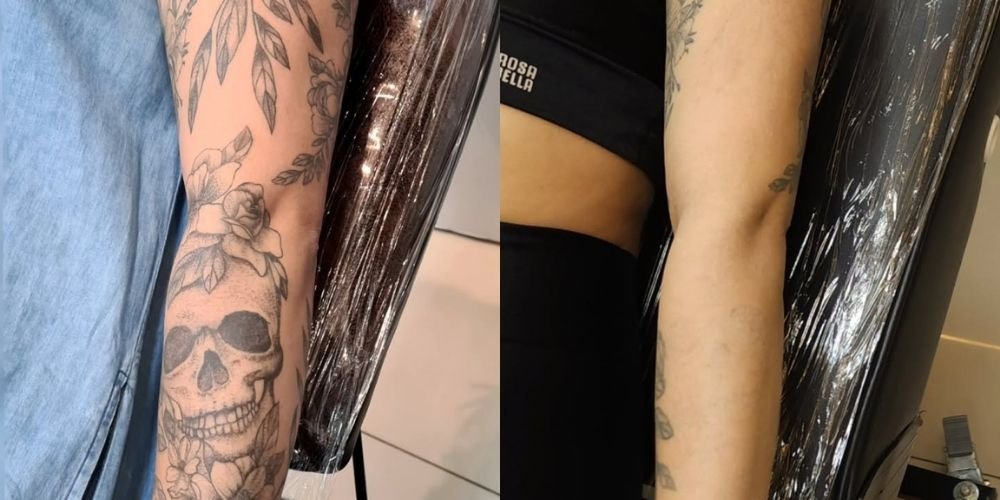 É Difícil Remover Tatuagem