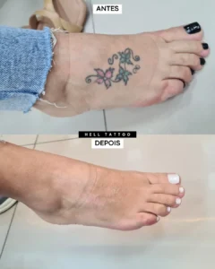 Remoção de tatuagem resultado_geração