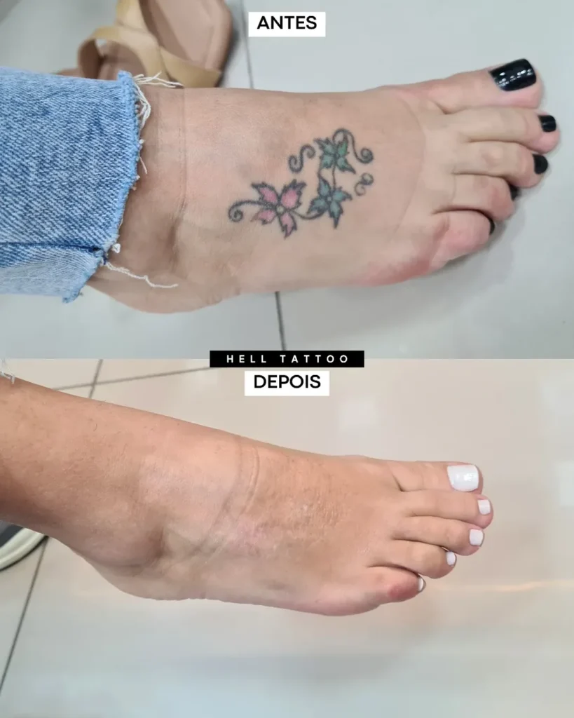 Remoção de tatuagem resultado_geração