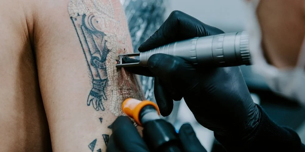 Frosting na Remoção de Tatuagem