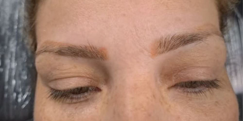 Remoção de Micropigmentação Laranja
