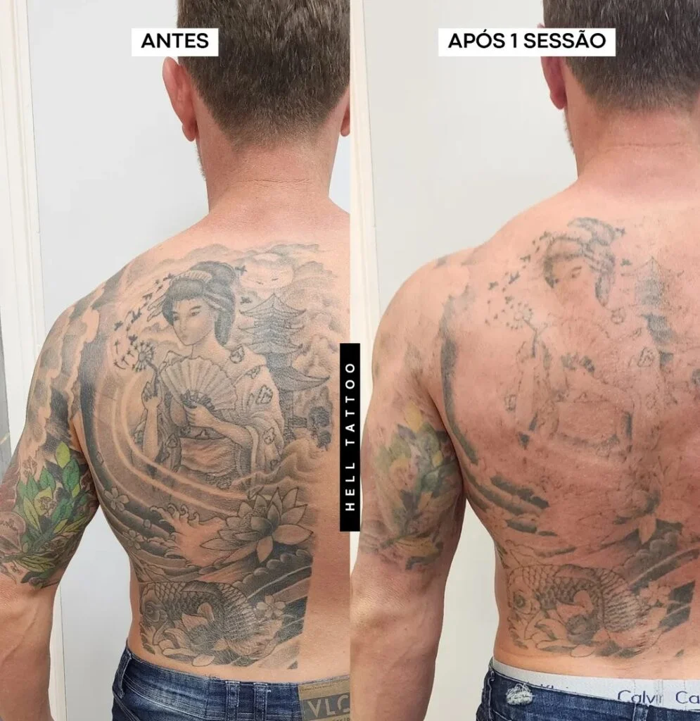 remocao-de-tatuagem-nas-costas