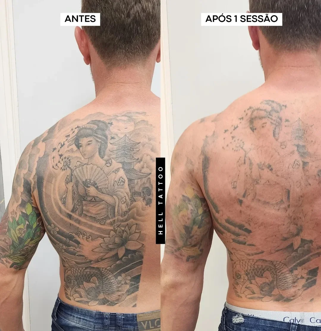 remocao-de-tatuagem-nas-costas