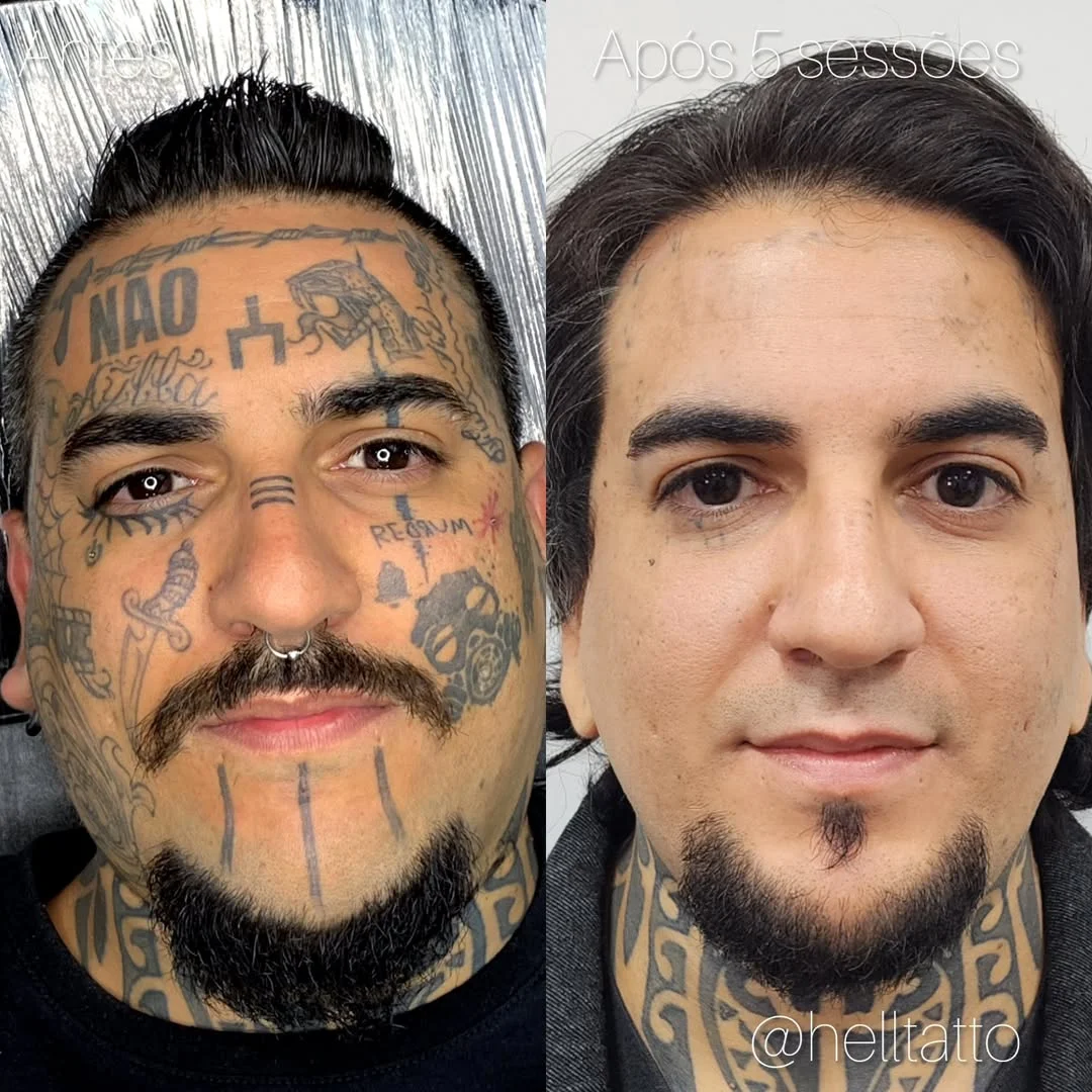 remoção de tatuagem tendência