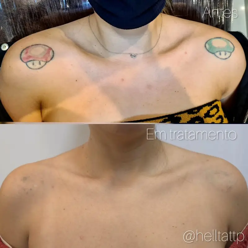 remocao-de-tatuagem-vermelha-e-possivel
