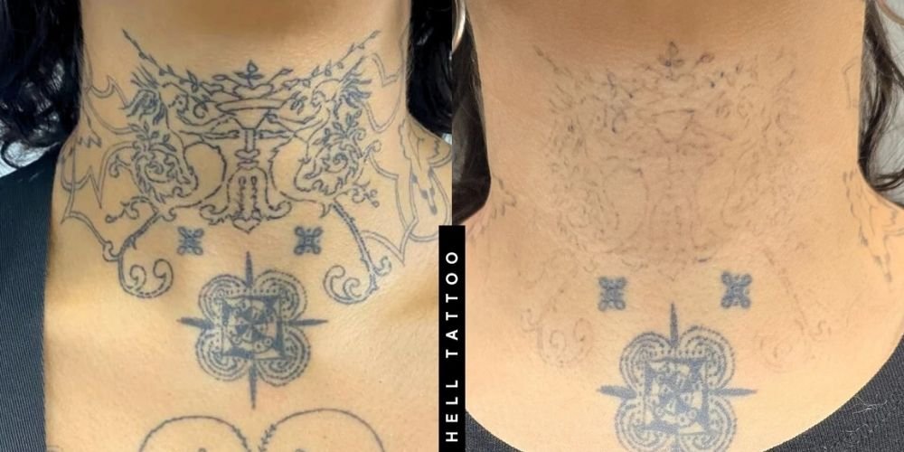 Remoção de tatuagem no pescoço