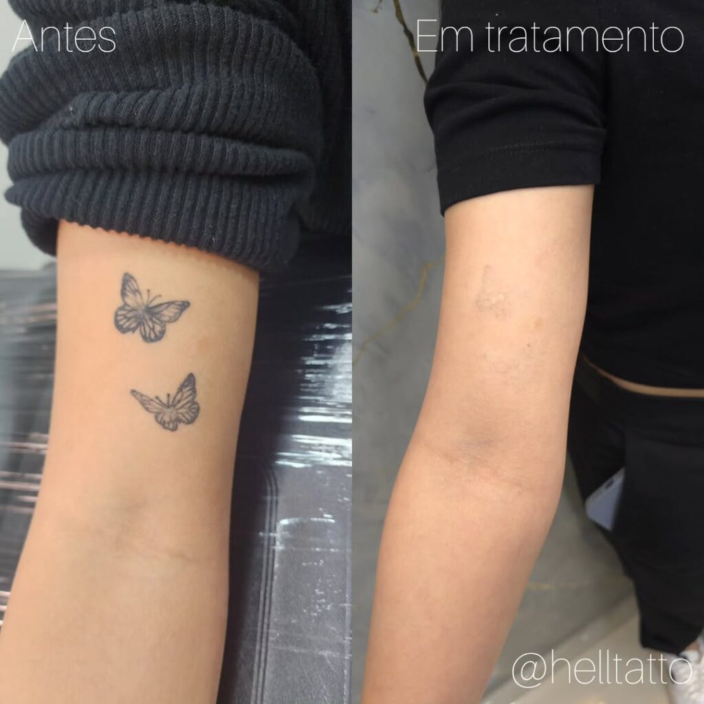 Remoção de tatuagem