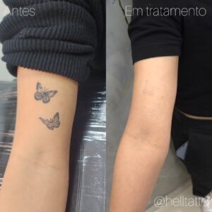 Remoção de tatuagem