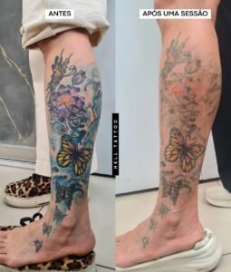 como-e-a-remocao-a-laser-de-uma-tatuagem-colorida