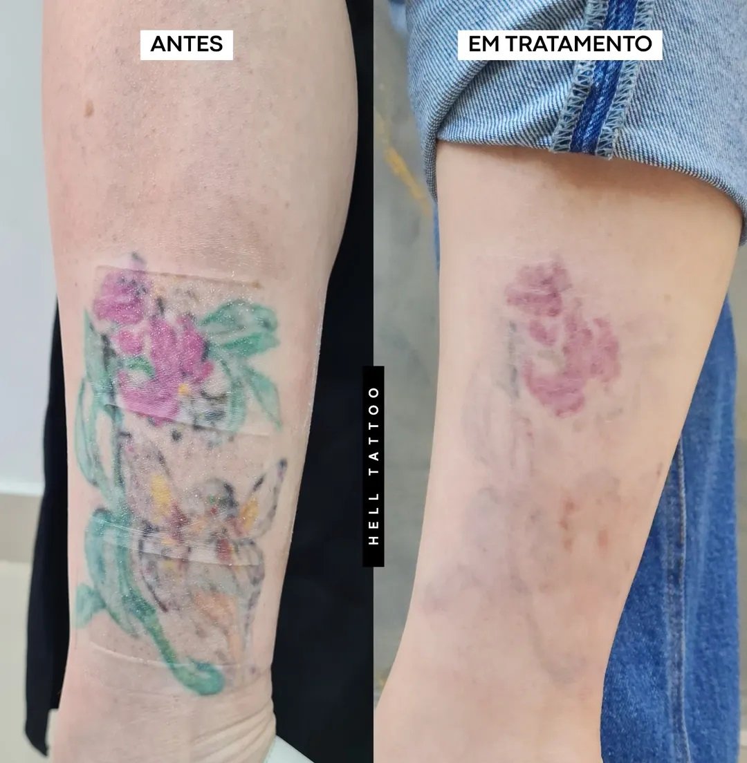 como-e-a-remocao-a-laser-de-uma-tatuagem-colorida