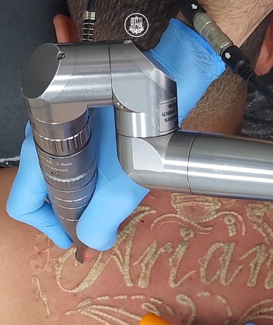 laser-bom-pode-remover-tatuagem