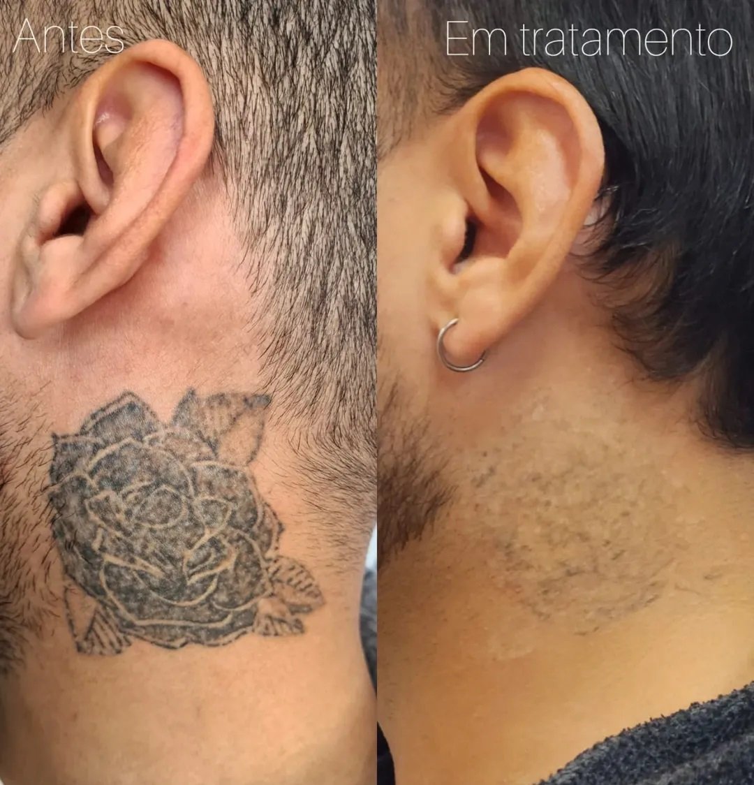 remocao-de-tatuagem-no-pescoco-vantagens-e-desafios