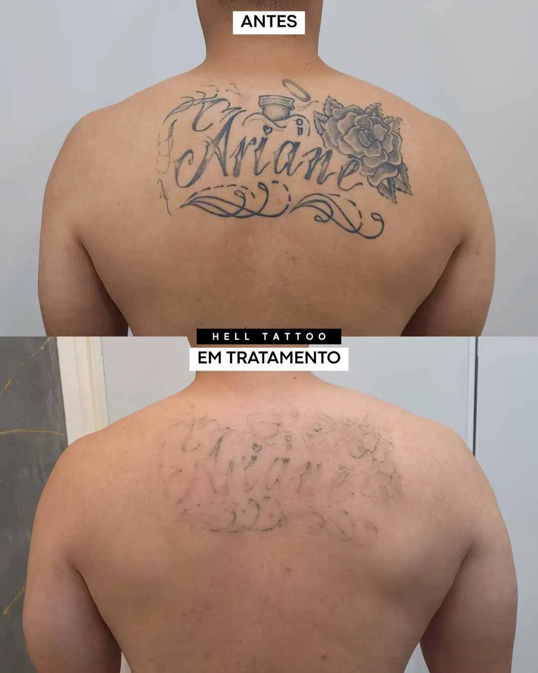 remoção de tatuagem segura 02