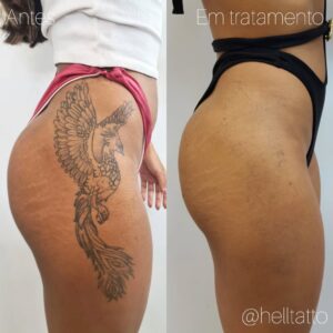 remoção de tatuagem segura