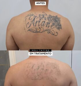 remover-uma-tatuagem-em-apenas-uma-sessao