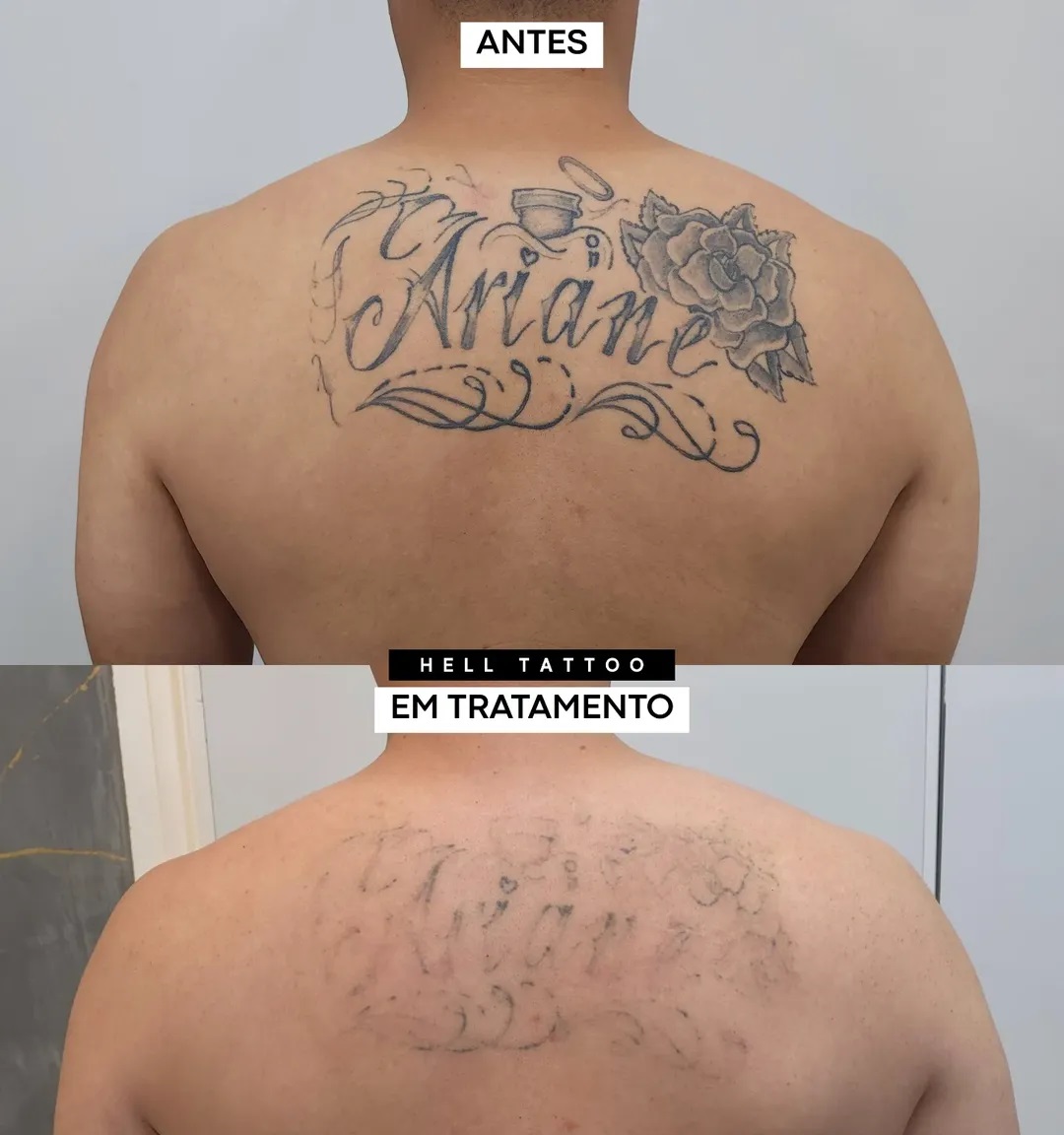 remover-uma-tatuagem-em-apenas-uma-sessao