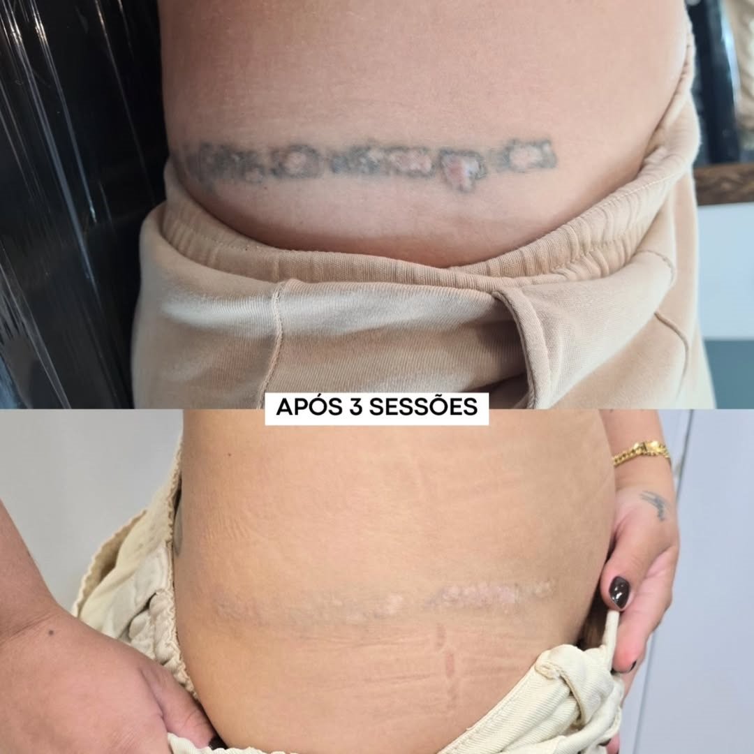 tatuagem-com-cicatriz-da-certo-fazer-remocao
