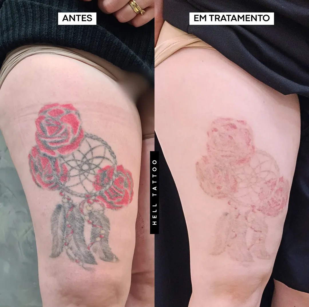 tatuagens-com-cicatrizes-da-certo-fazer-remocao-de-tatuagem