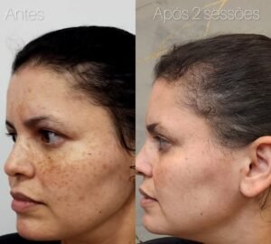 tratamento-de-melasma-a-laser-mitos-e-verdades-02