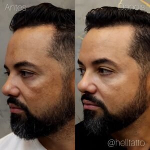 tratamento-de-melasma-em-homens