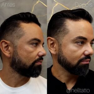 tratamento-de-melasma-em-homens