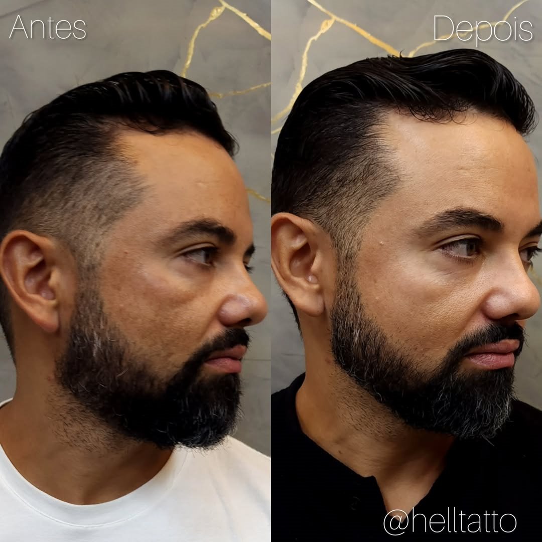 tratamento-de-melasma-em-homens