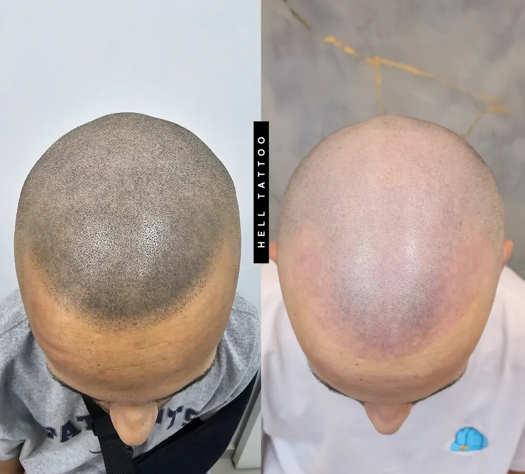 tratamento-de-remocao-de-micropigmentacao-capilar