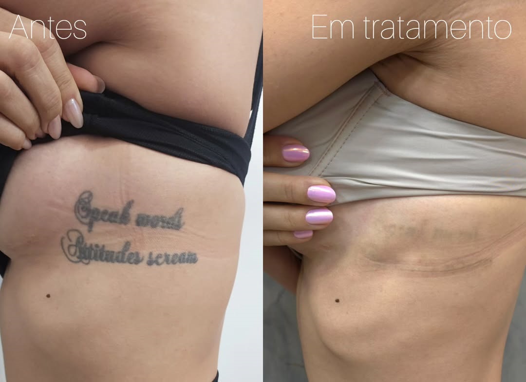 7-motivos-que-levam-a-remover-a-tatuagem