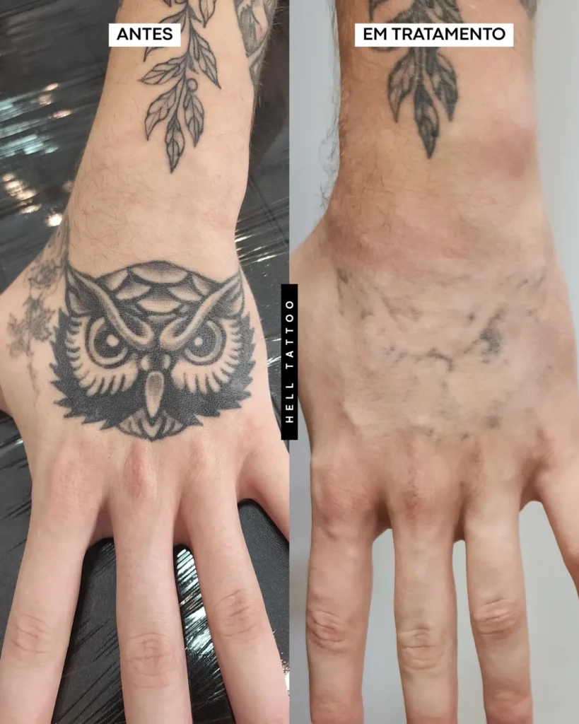 Remoção de Tatuagem em Belo Horizonte
