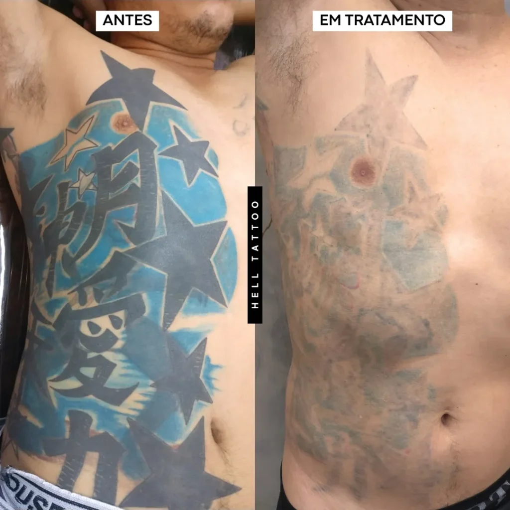 Remoção de tatuagem