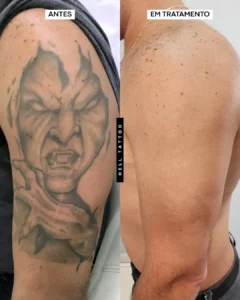 antes e depois remoção de tatuagem hell tattoo
