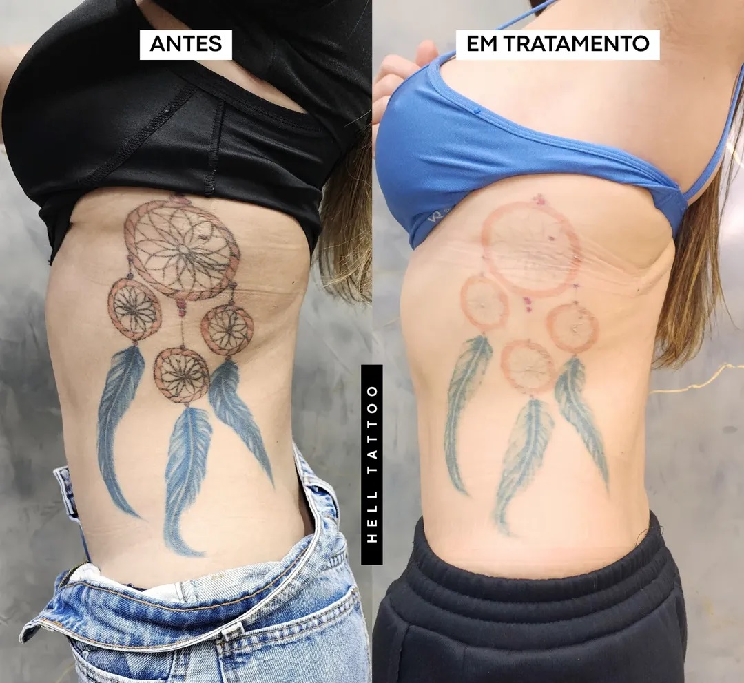 remocao-de-tatuagem-clareia-de-forma-uniforme