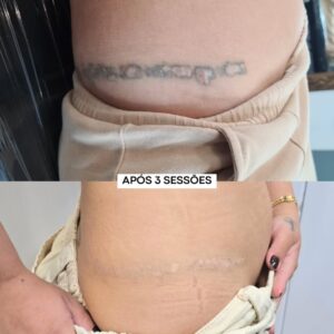 remocao-de-tatuagem-e-cicatrizes-como-tratar-ao-mesmo-tempo