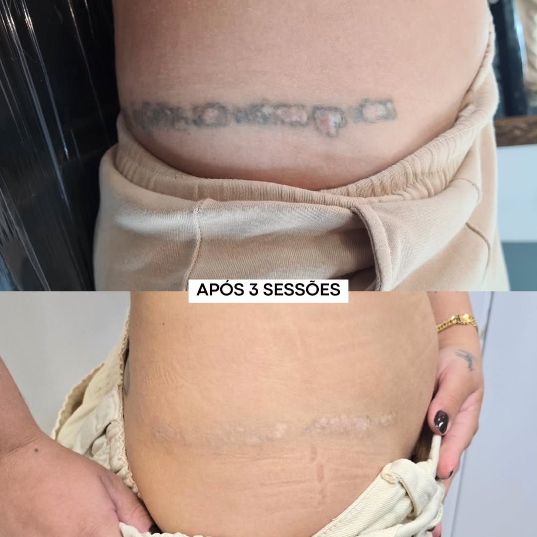 remocao-de-tatuagem-e-cicatrizes-como-tratar-ao-mesmo-tempo